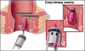 Мини-инвазивно (амбулаторно) лечение